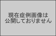 しもだ矯正歯科クリニックDamonSystem症例①右