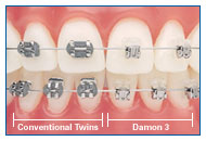 歯科矯正デーモンシステムimage