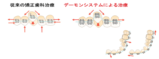 歯科矯正デーモンシステムimage