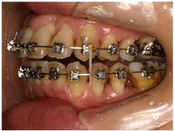 矯正歯科ブラケット装着状態