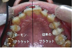 ブラケット装着状態■下顎