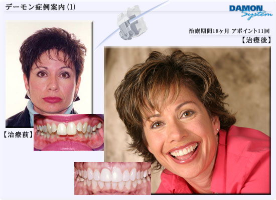 矯正歯科デーモンシステム■症例01　治療期間18ヶ月、アポイント回数11回