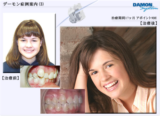 矯正歯科デーモンシステム■症例03　治療期間17ヶ月、アポイント回数9回