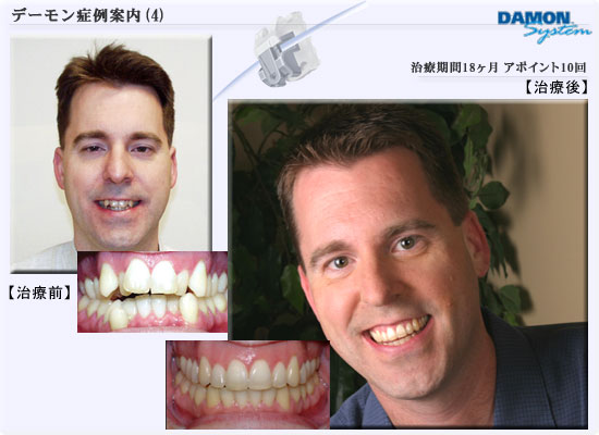 矯正歯科デーモンシステム■症例04　治療期間18ヶ月、アポイント回数10回