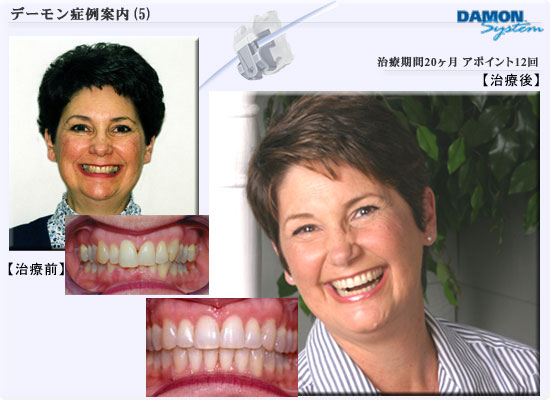矯正歯科デーモンシステム■症例05　治療期間20ヶ月、アポイント回数12回