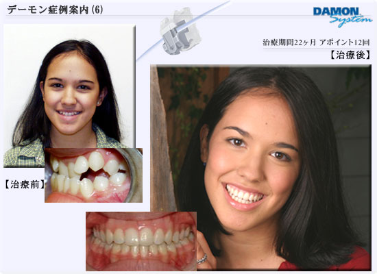 矯正歯科デーモンシステム■症例06　治療期間22ヶ月、アポイント回数12回