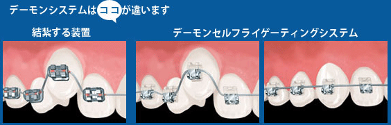 矯正歯科デーモンシステムimage